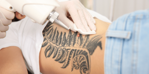 Unwanted Ink? Laser Tattoo Removal Clears It Fast!