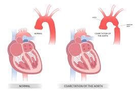Coarctation Of The Aorta in India: Advanced Treatment, Excellent Outcomes, and Affordable Costs