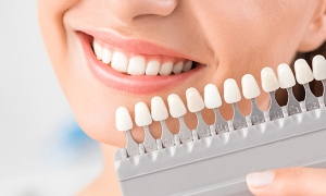 Tandenbleek Kits voor Salons: De Toekomst van Stralende Glimlachen