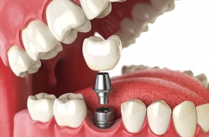 The Step-by-Step Process of Getting Dental Implants in Dubai