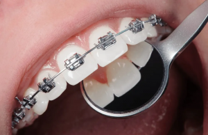 How Dental Braces Work: The Science Behind Straighter Smiles