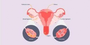 Regain Natural Ovulation: Laparoscopic Ovarian Drilling in India for PCOS
