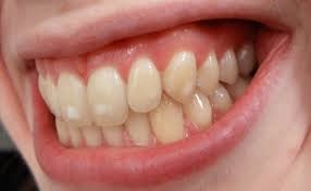 Is Dental Stain Removal Painful?