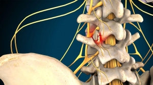 Understanding Facet Syndrome: Causes, Symptoms, and Treatment Options