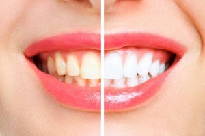 How to Keep Your New Smile Straighter After Braces Treatment