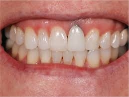 What Are the Symptoms of Dental Implant Infection?