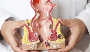 Your Guide to the Best Fissure Treatment in Delhi – Safe, Private & Proven