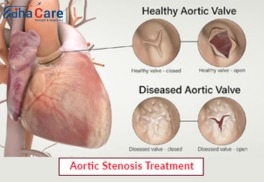 Un cœur renouvelé : Traitement de la sténose aortique en Inde