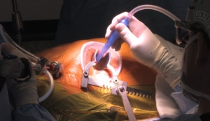 How Keyhole Heart Surgery Is Transforming Cardiac Care