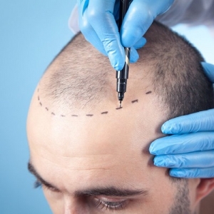 FUE Hair Transplant: Cost in Dubai