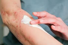 Waking Up with Bites? Bed Bug Symptoms to Watch For
