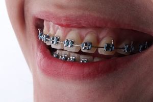 Do Metal Braces Affect Speech? Tips to Adapt Quickly