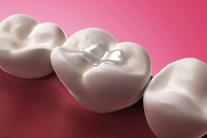 Are You a Candidate for Dental Implants? Here's How to Tell