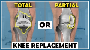 Find Relief from Arthritis: Partial vs. Total Knee Replacement in Delhi