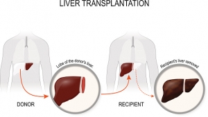 Breaking Down Liver Transplant Cost in Singapore – ALPS Clinic Insights