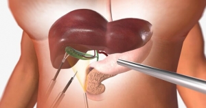 Gallbladder Surgery Singapore: When It’s Needed and What to Expect