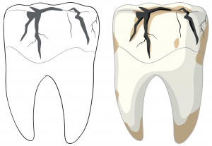 Cavity on Front Tooth: Causes, Symptoms, Treatment & Prevention