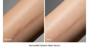 DermalMD Stretch Mark Serum: Before & After Results Explained