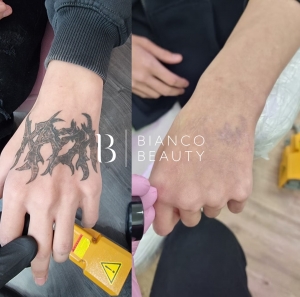 Laser Tattoo Removal vs Other Methods: What Works Best?