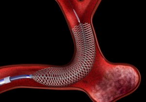 Vascular Embolization Market Size, Share, Trends, and Growth Forecast 2025-2032
