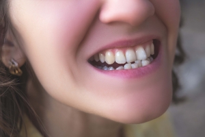 The Role of Dental Contouring in Treating Overlapping Teeth