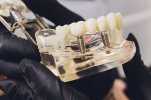 Get Your Confidence Back with Teeth Implants Birmingham