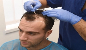 Hair Transplant for Male Pattern Baldness in Islamabad