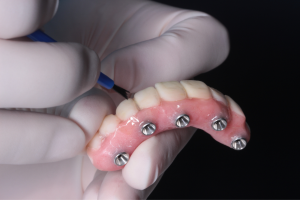 Full Mouth Dental Implants: Restore Your Smile and Confidence