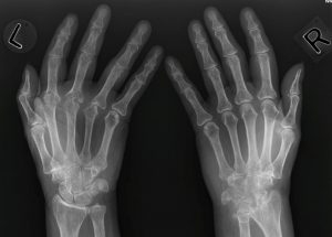 Erosive Hand Osteoarthritis Market Size, Trends, and Growth Analysis 2025-2032