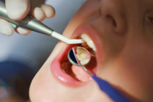What to Expect During Your First Teeth Scaling Appointment