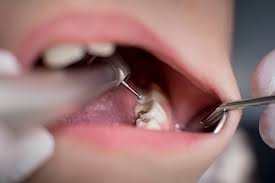 Do I Need a Root Canal on My Back Tooth?