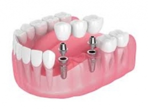 Restore Your Smile with Dental Crowns & Bridges at Shrivastava Dental Clinic — Bhopal’s Trusted Dental Experts