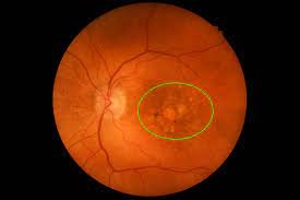 Intermediate AMD Market Size, Trends, and Growth Forecast 2025-2032