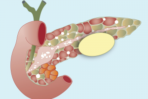 Understanding Chronic Pancreatitis — Causes, Symptoms & Treatment | Digestive Surgery Clinic — Dr. Sachin Arora