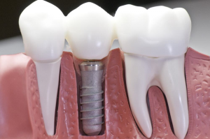The Anatomy of a Dental Implant: Breaking It Down Simply