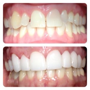 Preventive Dentistry in Denton: Keeping Your Smile Healthy for Life