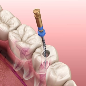 Get Treated While on Vacation: Root Canal Treatment in Dubai
