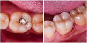 Does Amalgam Removal Release Mercury Into the Body?