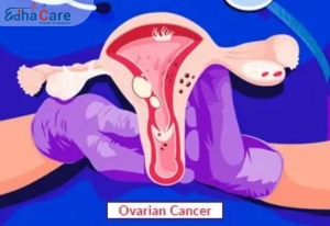 Tout savoir sur le Traitement du cancer de l'ovaire en Inde : options, efficacité et accessibilité