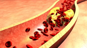 Global Hypercholesterolemia Market Size, Trends, and Growth Analysis 2025-2032
