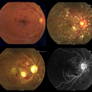 Retinal Vein Occlusion Market Size, Trends, and Growth Forecast 2025-2032