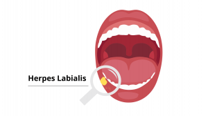 Herpes Labialis Market Size, Trends, and Growth Strategies to 2032