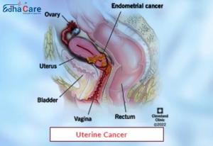Espoir et expertise : le Traitement du cancer de l'utérus en Inde