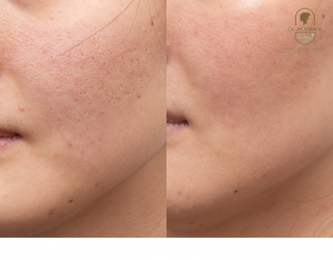 Fractional RF Skin Resurfacing Treatment