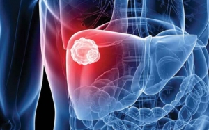 Advanced Liver Cancer Market: Size, Trends, and Growth Insights 2025-2032
