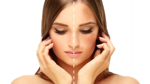 How To Remove Pigmentation From Face Permanently In Easy Ways