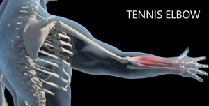 Manage Tennis Elbow with Targeted Support Devices