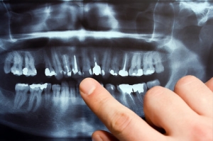 What to Expect During a Panoramic Dental X-Ray?