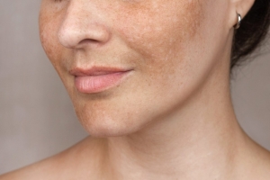 How To Remove Pigmentation From Face Permanently and Be Smooth