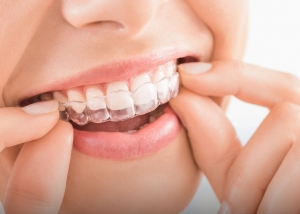 Cherry Hill Invisalign – Clear Braces in Pennsauken, NJ